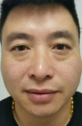 去眼袋手术