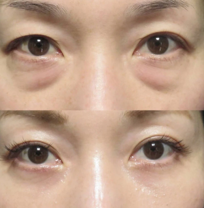 眼袋