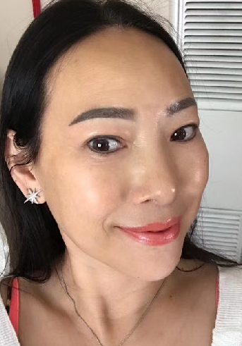 去眼袋手术