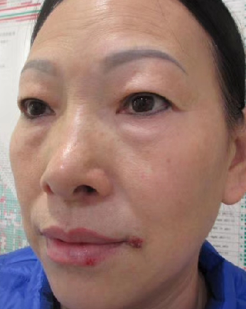 去眼袋手术