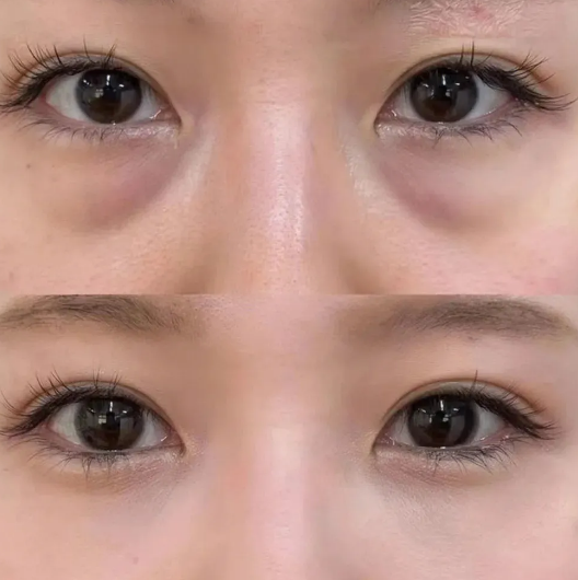 去眼袋手术