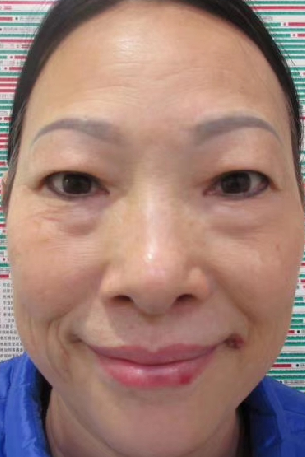 去眼袋手术