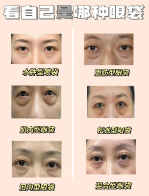 眼袋