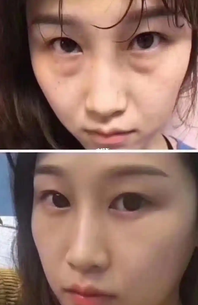 眼袋