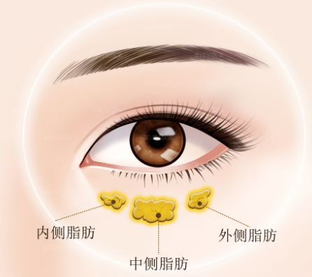 眼袋