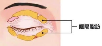 眼袋