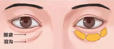 眼袋