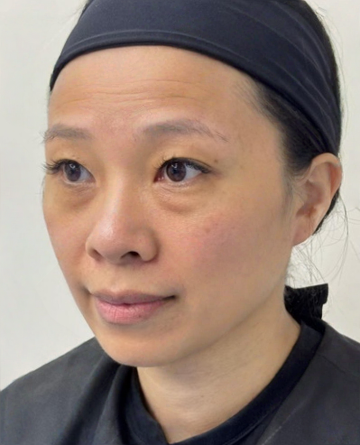 去眼袋手术