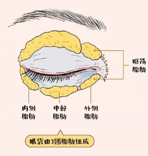 去眼袋手术