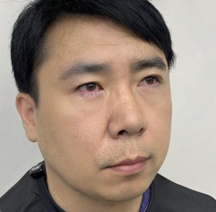 去眼袋手术