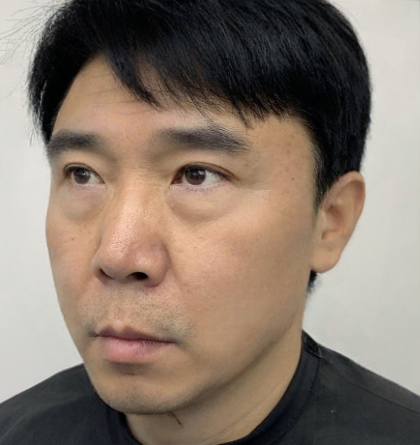 去眼袋手术