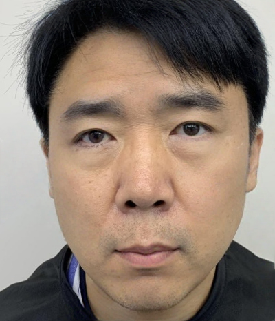 去眼袋手术