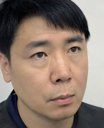 去眼袋手术