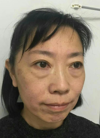 去眼袋手术
