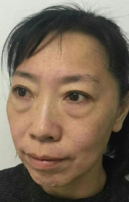 去眼袋手术