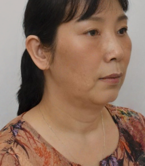 去眼袋手术