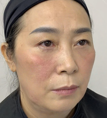 去眼袋手术