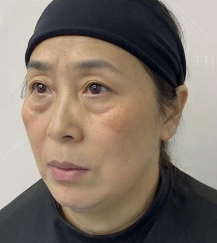 去眼袋手术
