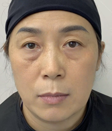 去眼袋手术