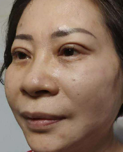 双眼皮手术