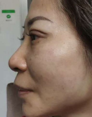 双眼皮手术