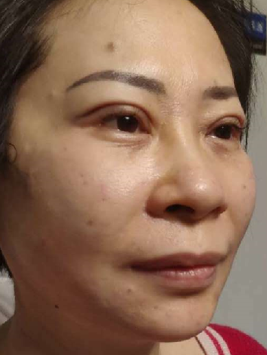 双眼皮手术