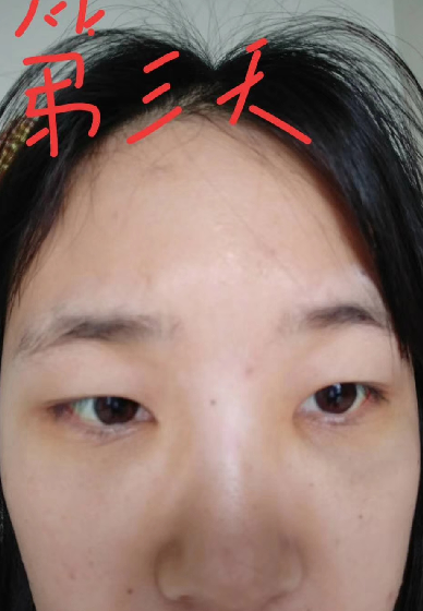 去眼袋手术