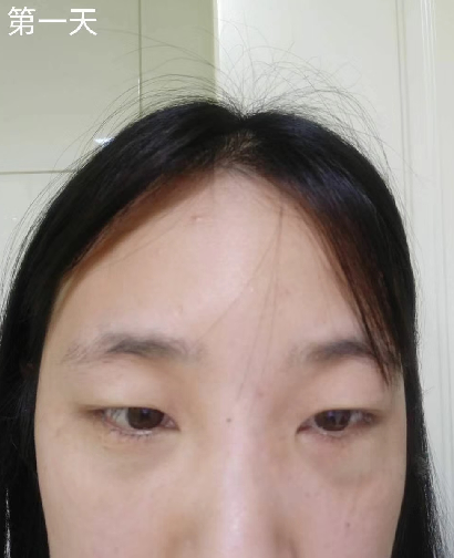 去眼袋手术