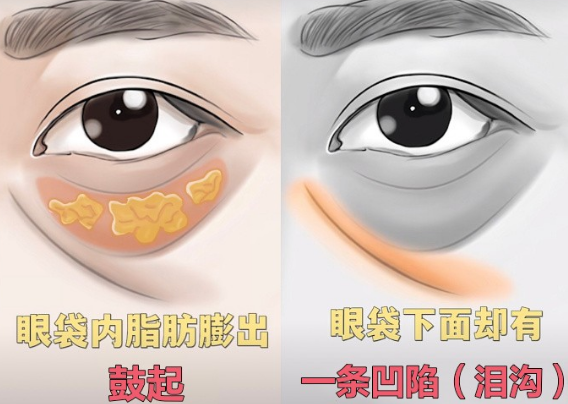 去眼袋手术
