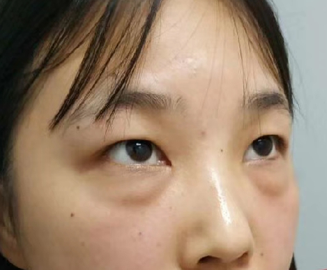 去眼袋手术