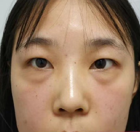 去眼袋手术
