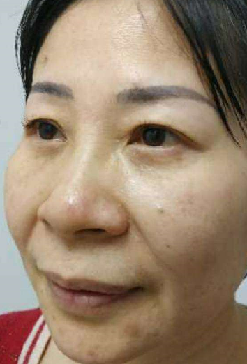 双眼皮手术