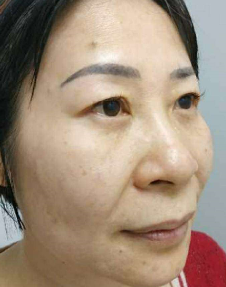 双眼皮手术