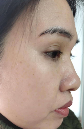 去眼袋手术