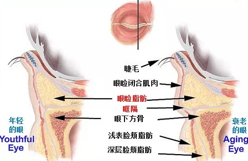 去眼袋手术