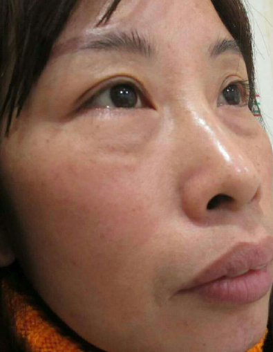 去眼袋手术