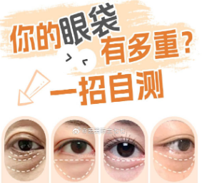 去眼袋手术