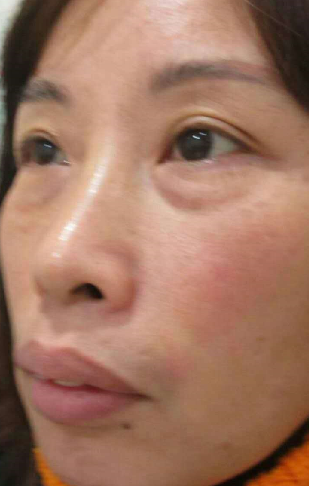 去眼袋手术