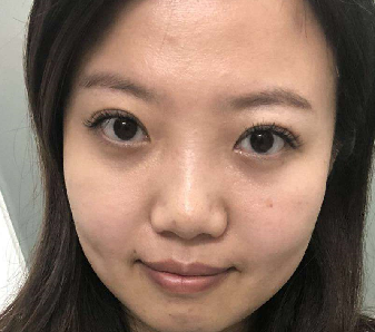 去眼袋手术