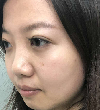 去眼袋手术