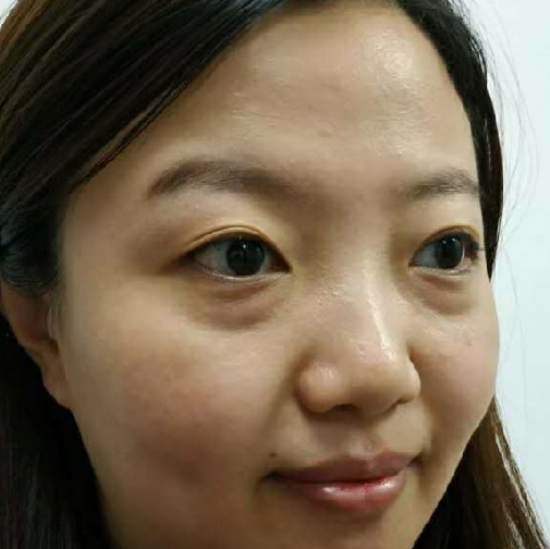 去眼袋手术