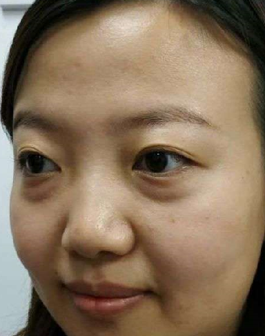 去眼袋手术