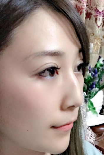 去眼袋手术
