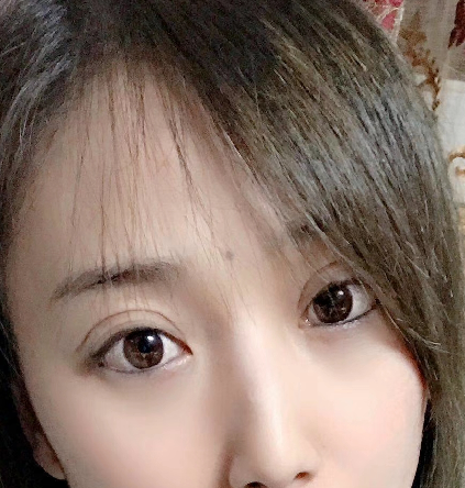 去眼袋手术