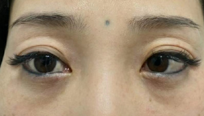 去眼袋手术