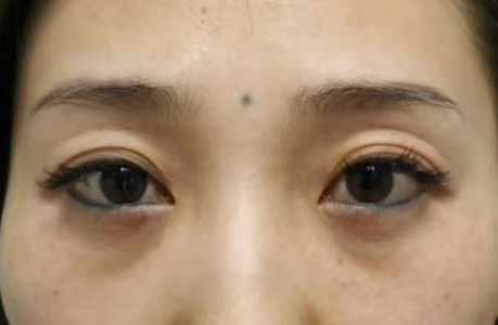 去眼袋手术