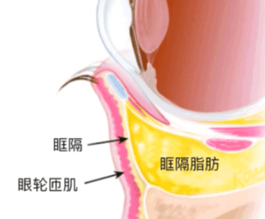 去眼袋手术