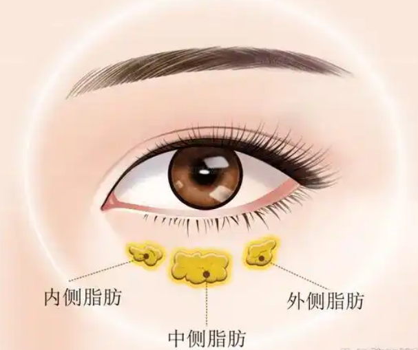 去眼袋手术