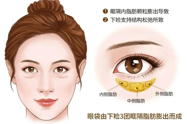 去眼袋手术