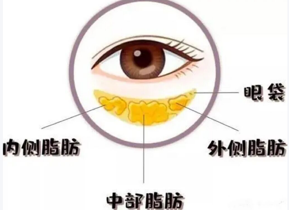 眼袋